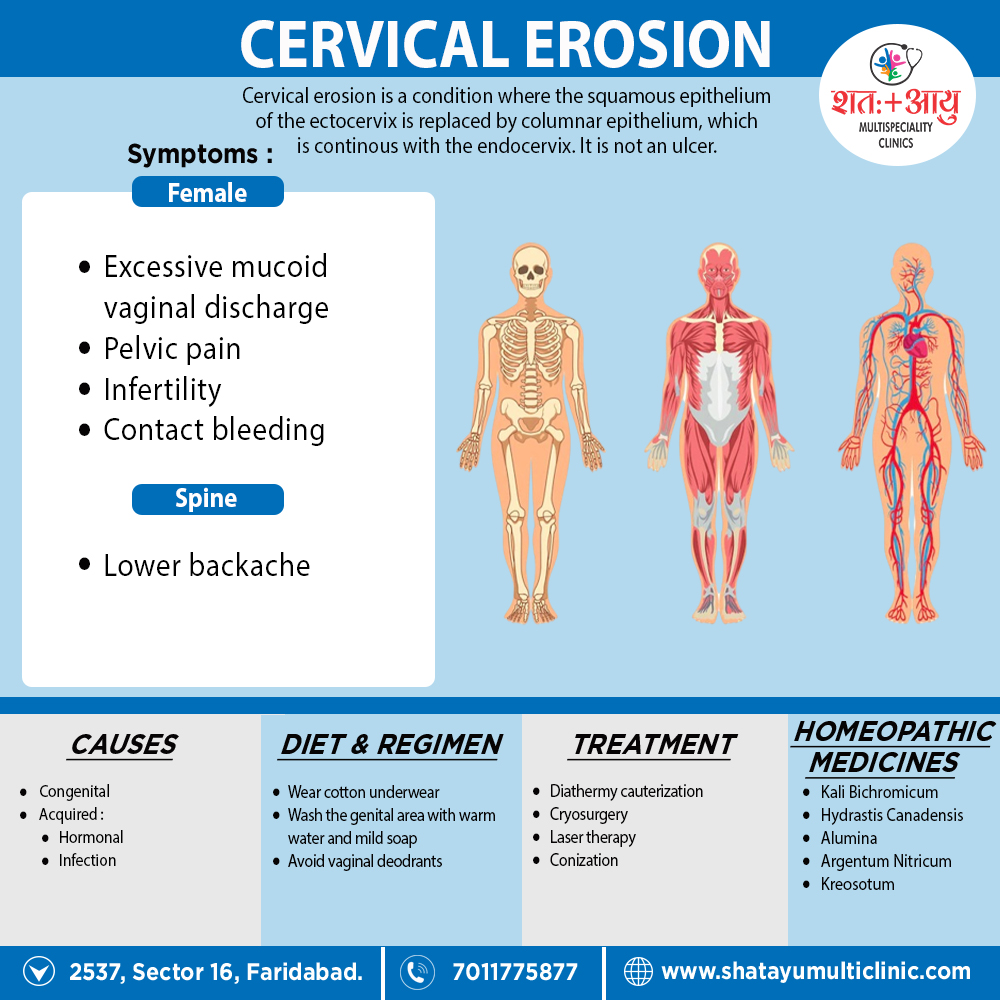 Cervical Erosion Painful Intercourse